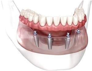 ball-locator-retained-over-denture