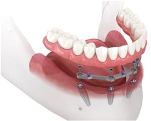 bar-retained-over-denture